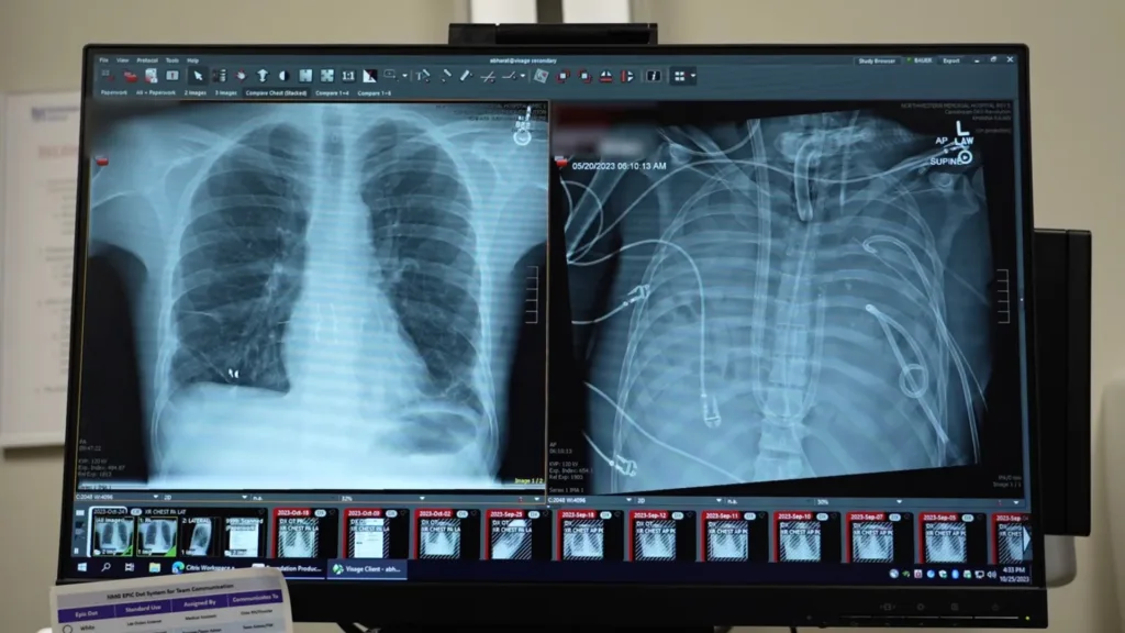 A supraviețuit 48 de ore fără plămâni: o procedură inovatoare a creat puntea către transplantul dublu de plămâni