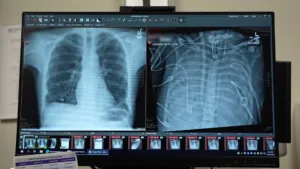 A supraviețuit 48 de ore fără plămâni: o procedură inovatoare a creat puntea către transplantul dublu de plămâni